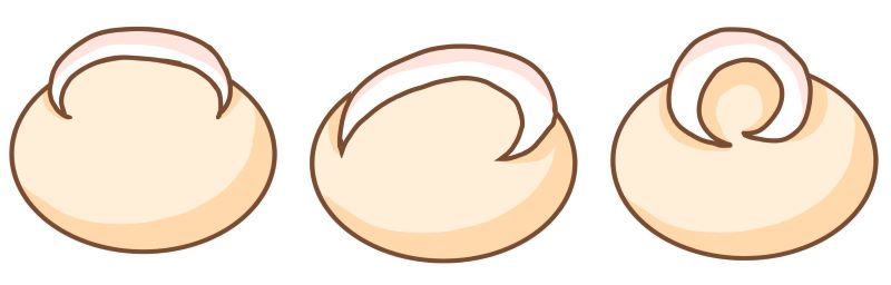 巻き爪の種類