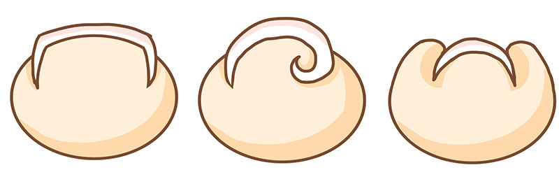 巻き爪の種類2